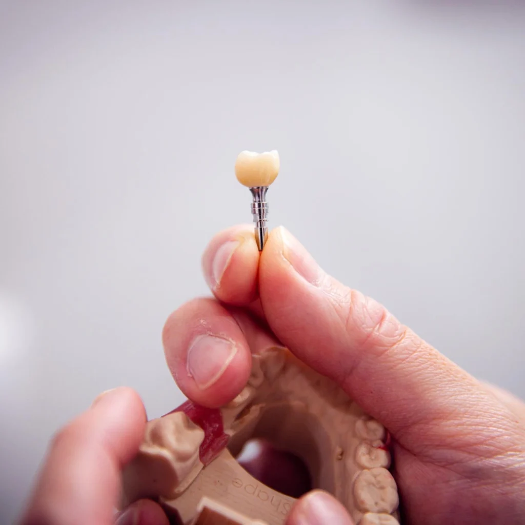 Single Implants at Greenvale Dental House