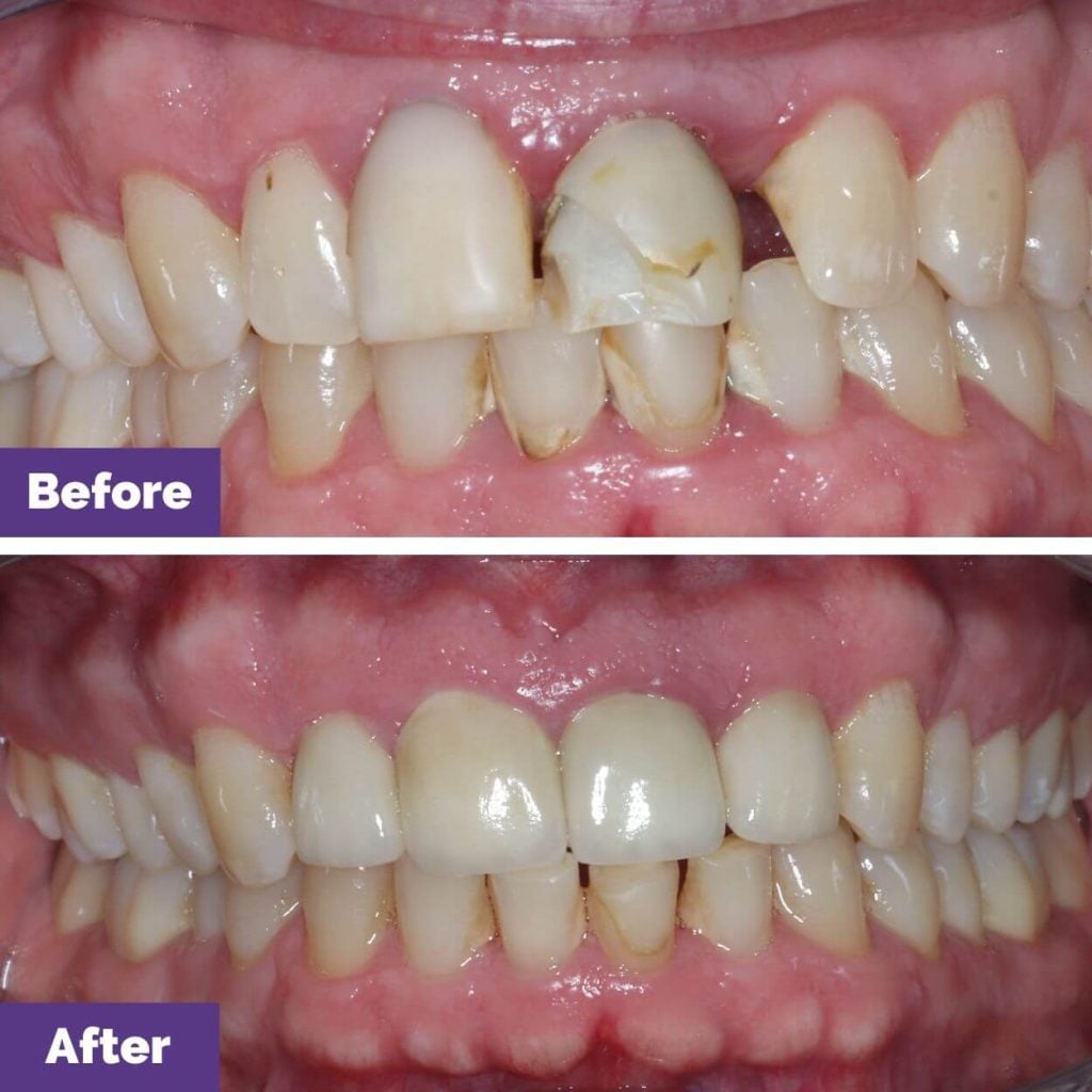 E's Porcelain Veneers Journey in New Gisborne
