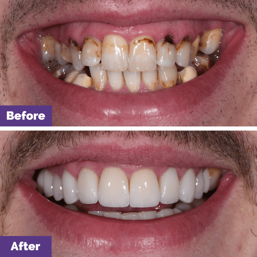 Brandon's Root Canal, Crowns, Porcelain Veneers and Implants Journey in Melton