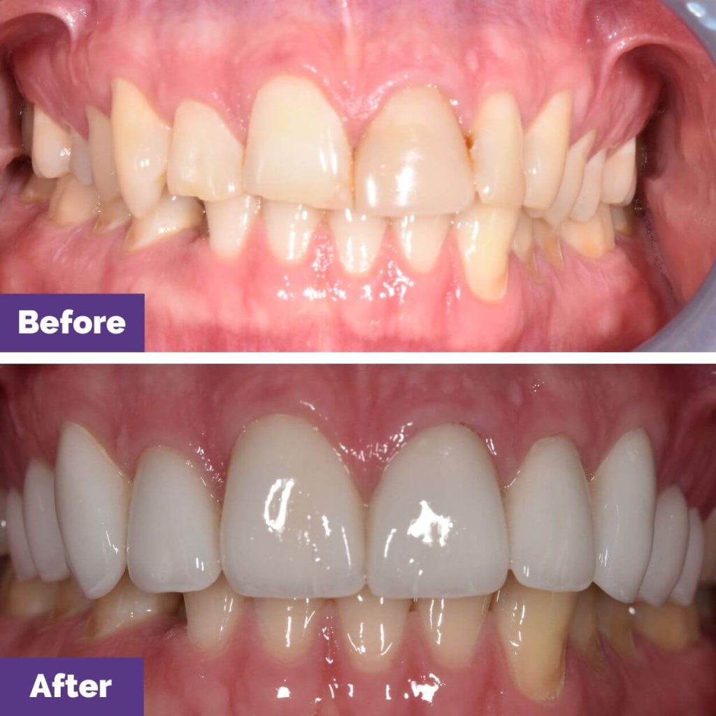 Cameron’s Ceramic Veneers Journey In Sunbury Cameron's Ceramic Veneers Journey in Sunbury