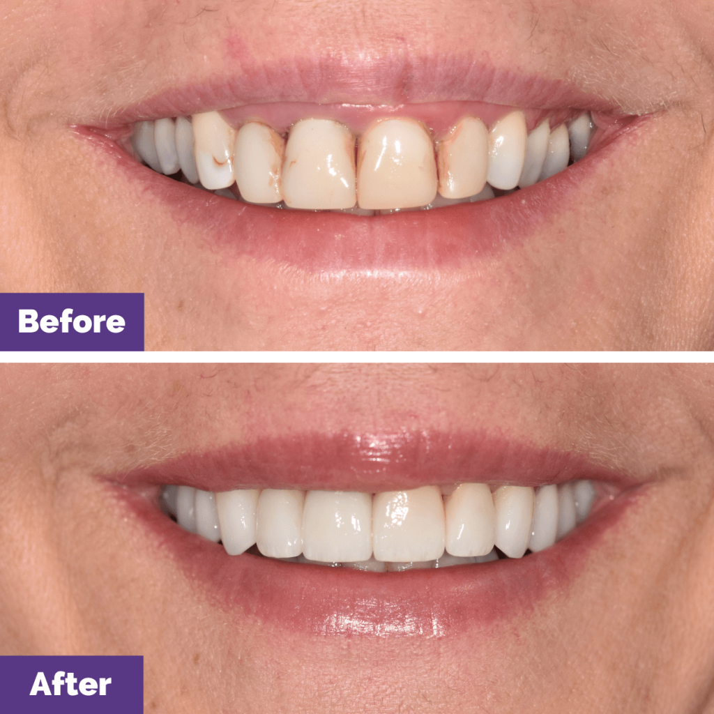 Alisa's Crowns and Veneers Journey in Sunbury