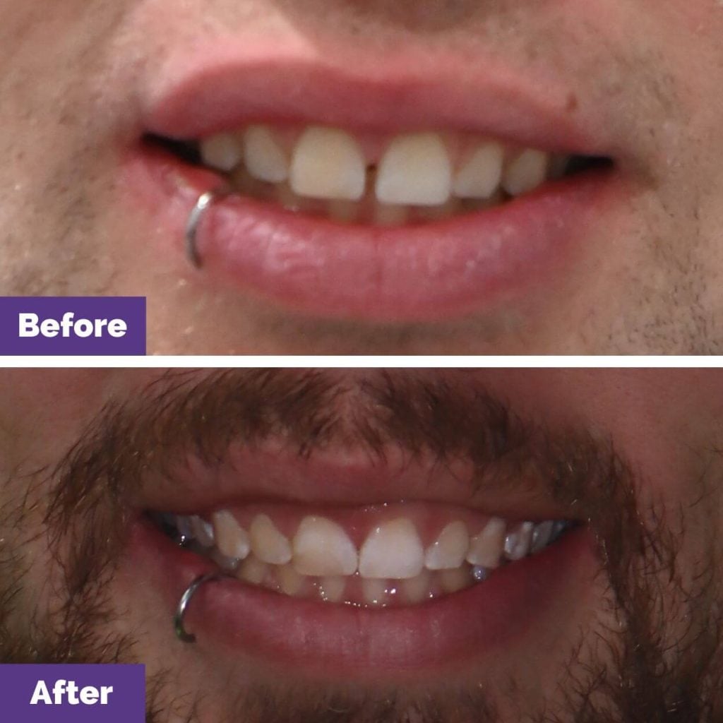 Mitchell's Invisalign Journey in Sunbury