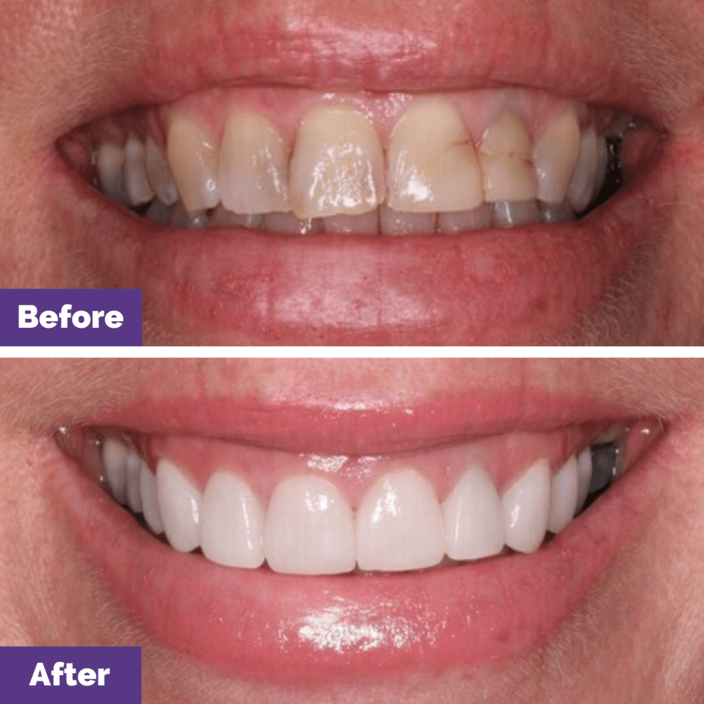 V's Porcelain Veneers Journey in New Gisborne
