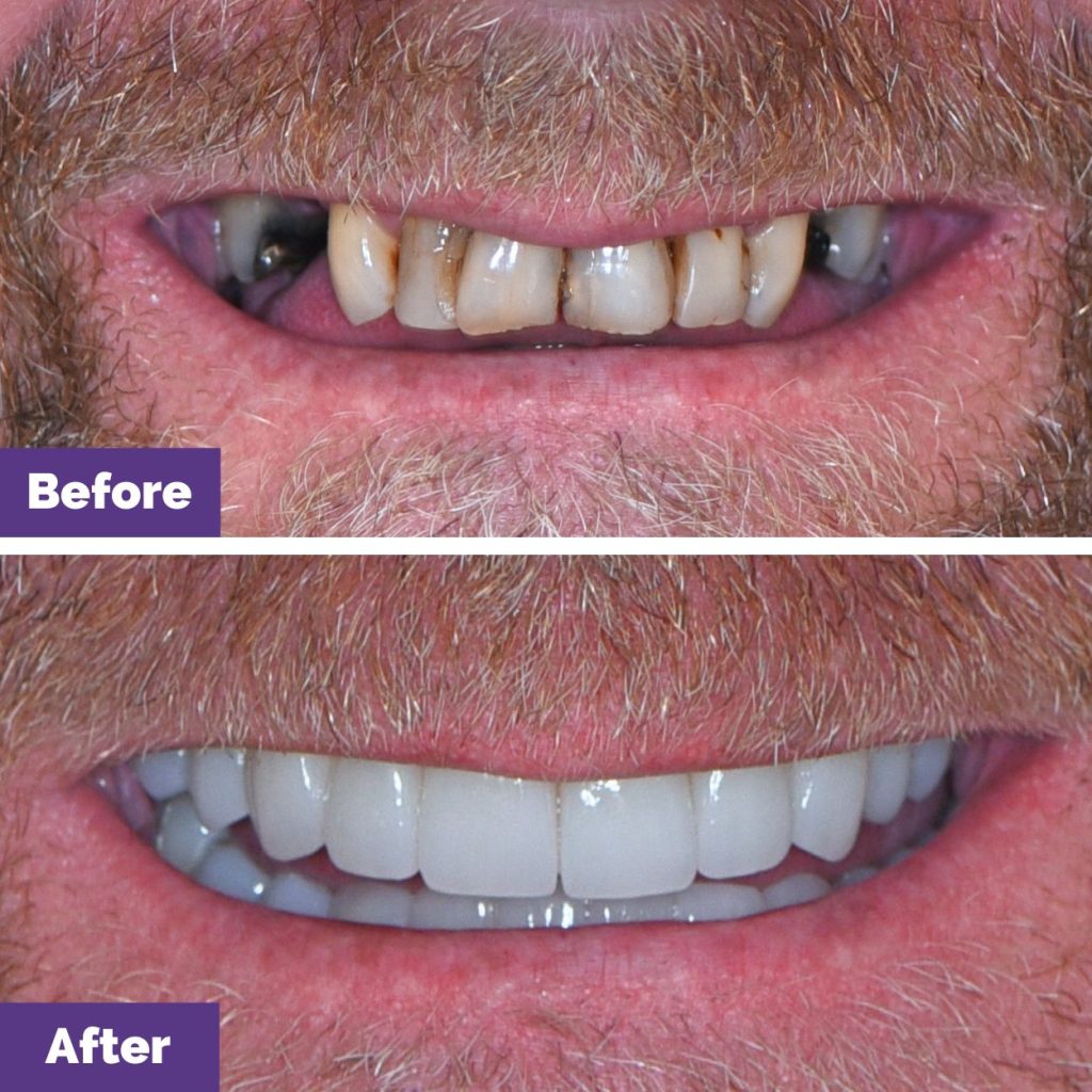 Danny Of Melton’s Dental Implants And Dental Veneer Journey In Dental House Danny Of Melton’s Dental Implants And Dental Veneer Journey