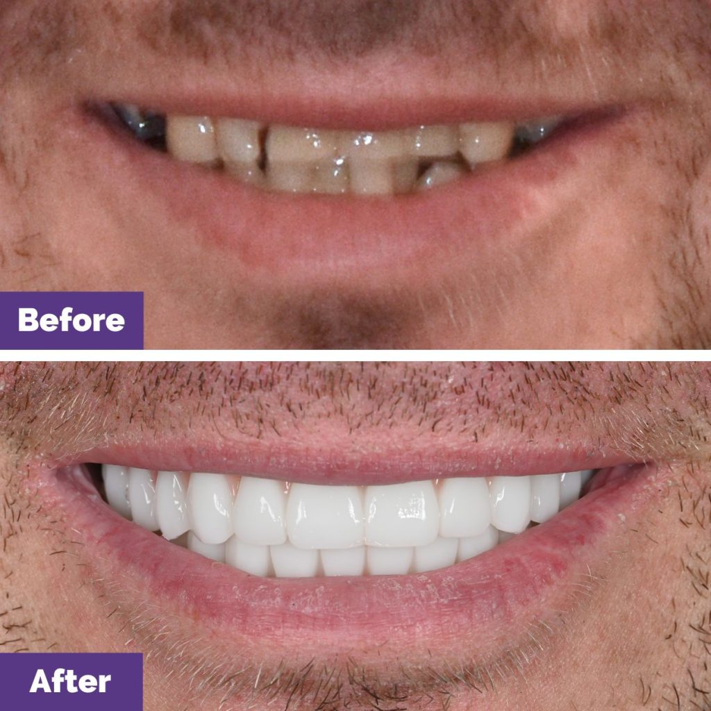 Dean Of Bacchus Marsh’s All On 4 Journey In Dental House Dean Of Bacchus Marsh's All On 4 Journey