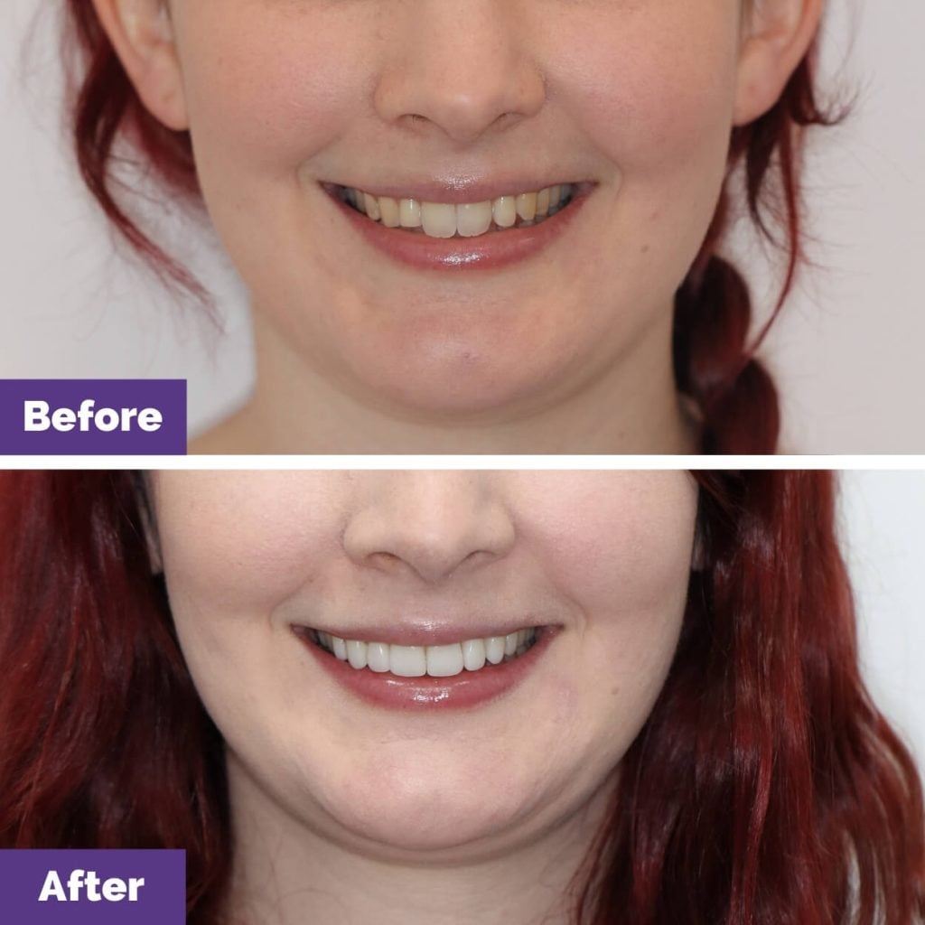 Elisa’s Porcelain Veneers In Sunbury Elisa’s Porcelain Veneers in Sunbury
