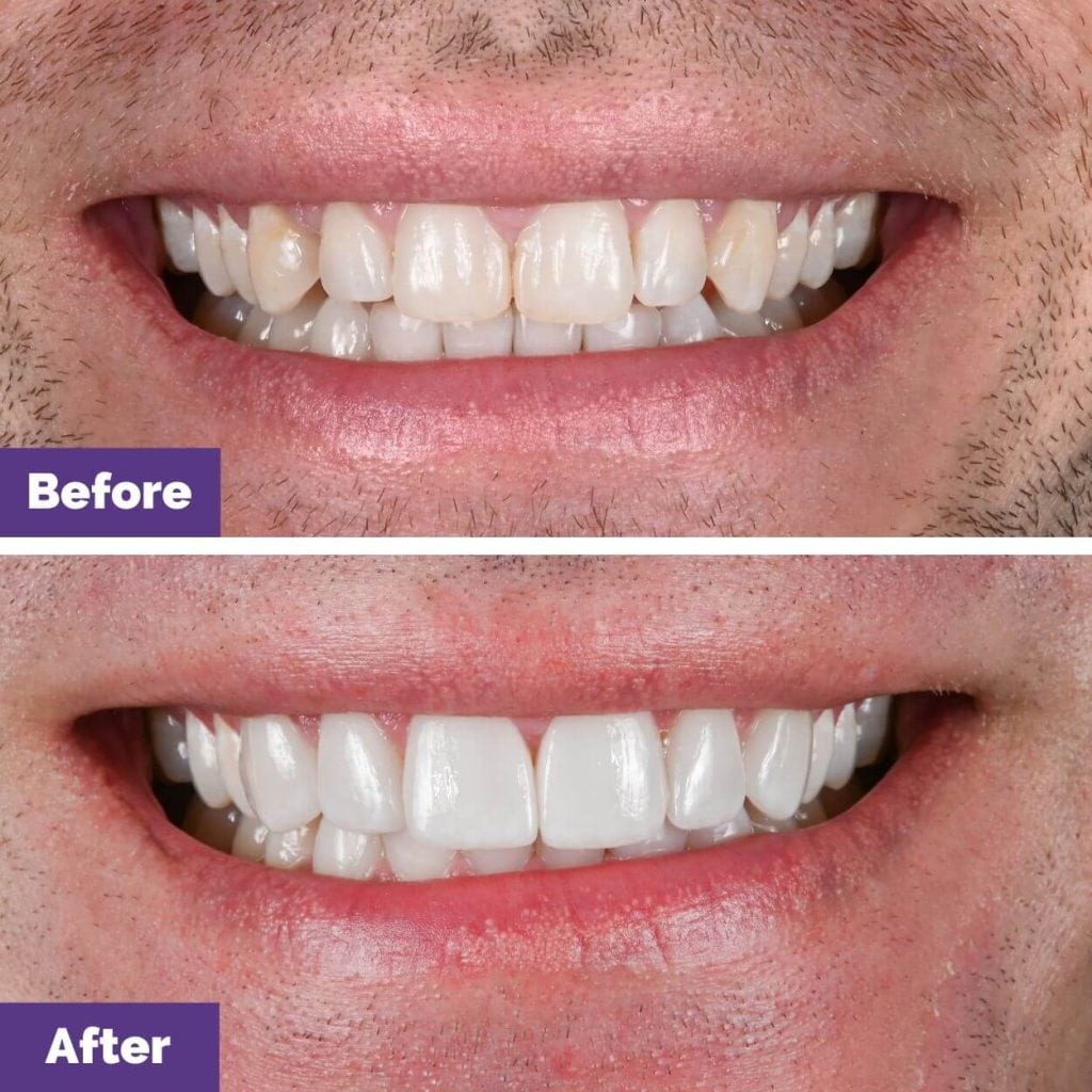 El's Porcelain Veneers Journey In Sunbury