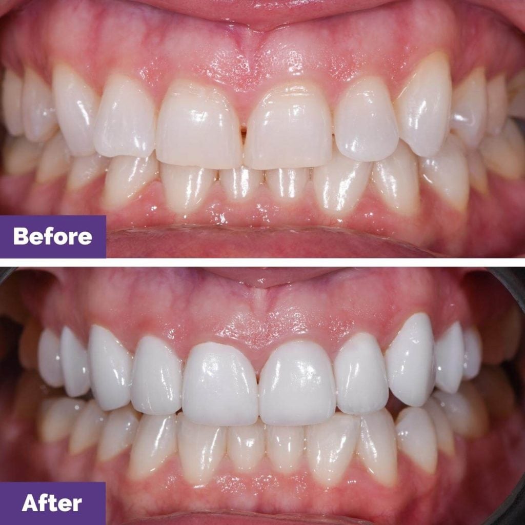 Emily's Porcelain Veneers Journey in Sunbury