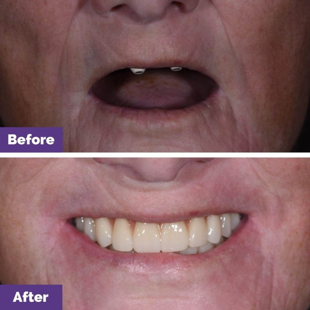 Gayle's All-On-4 Implants Journey in Sunbury