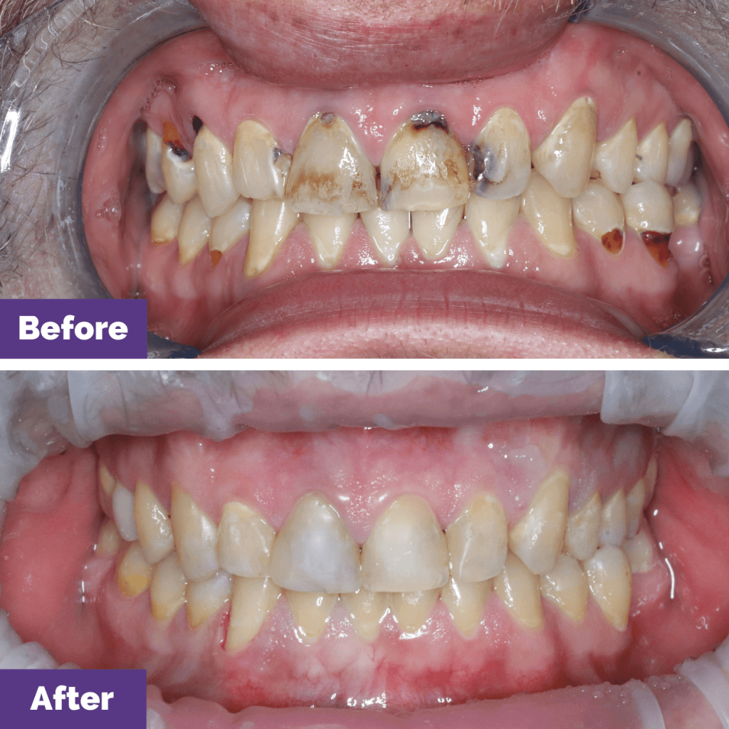 Grant’s Dental Crowns Journey In Gisborne Grant's Dental Crowns Journey in Gisborne