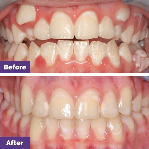 James Of Melbourne’s Fixed Braces Journey James Of Melbourne's Fixed Braces Journey