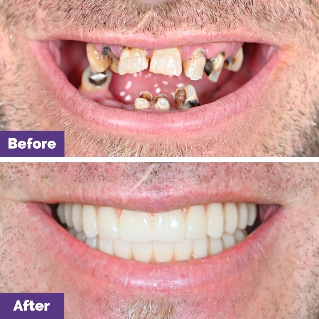 James Of Melton’s All On 4 Dental Implant Journey In Dental House James Of Melton's All On 4 Dental Implant Journey
