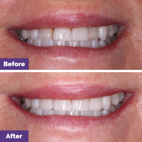 Jane Of Gisborne’s Porcelain Crowns Journey