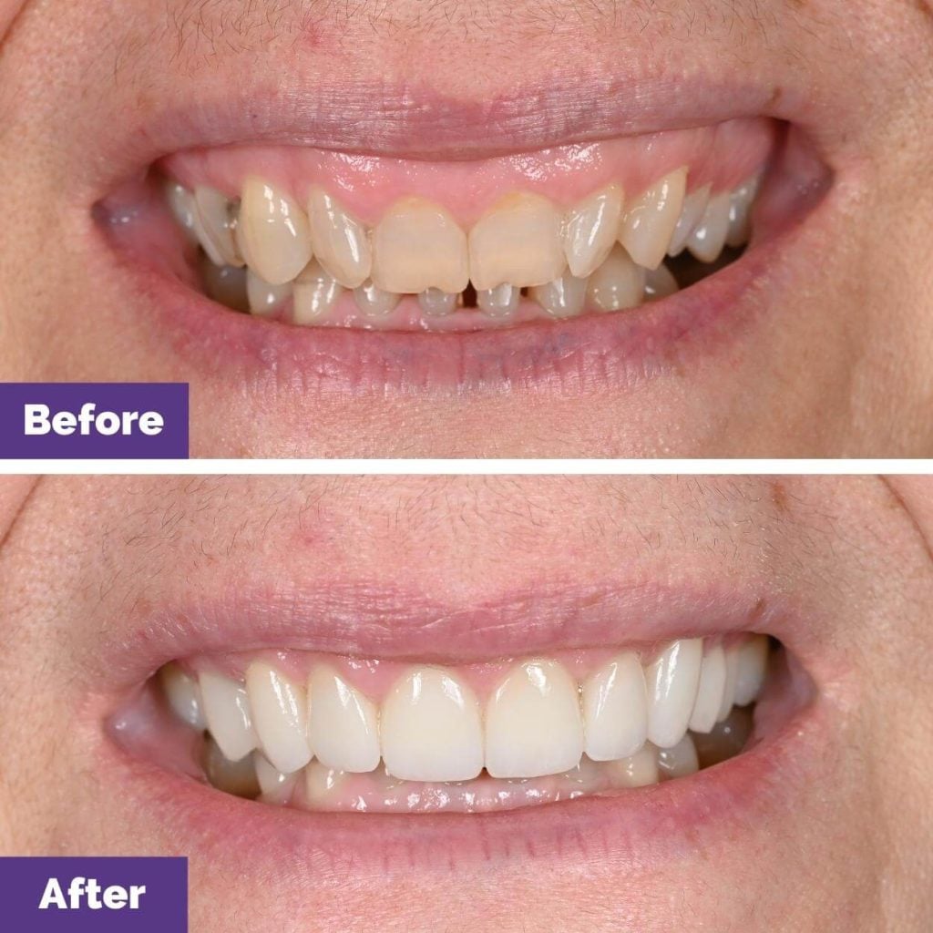 Joanna's Porcelain Veneers Journey in Sunbury