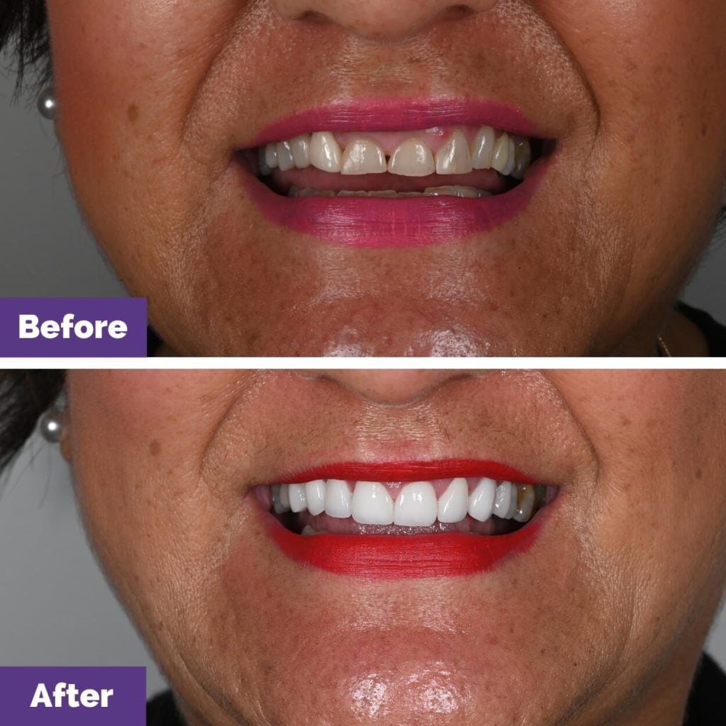 Joanna’s Porcelain Veneers And Bridge Journey In Sunbury Joanna's Porcelain Veneers and Bridge Journey in Sunbury