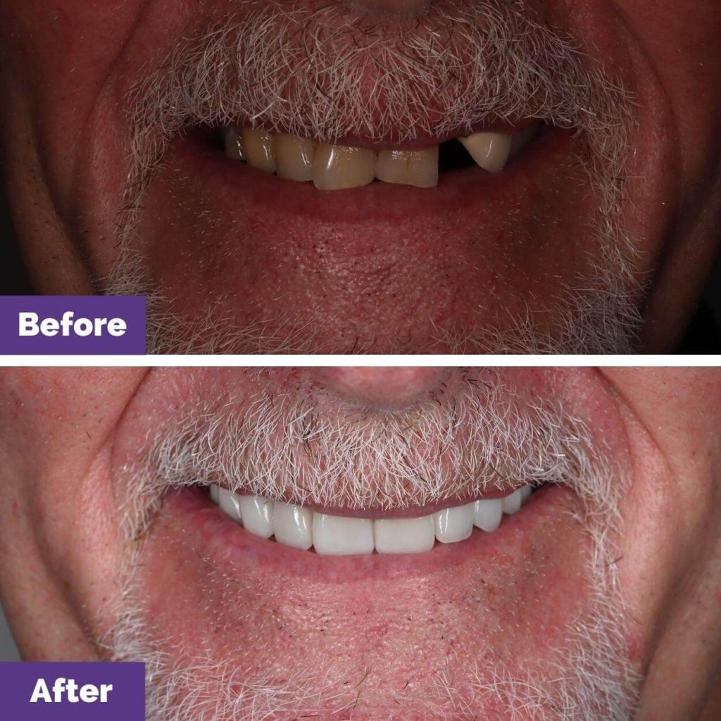 John's Porcelain Veneers Journey in Sunbury
