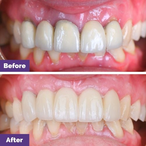 Joseph Of Melbourne’s Dental Implant, Crown And Bridges Journey In Dental House Joseph of Melbourne's Dental Implant, Crown and Bridges Journey In Dental House