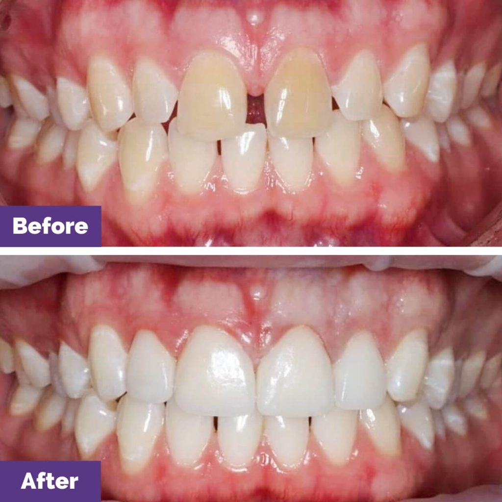 Josh’s Porcelain Veneers Journey in Melbourne