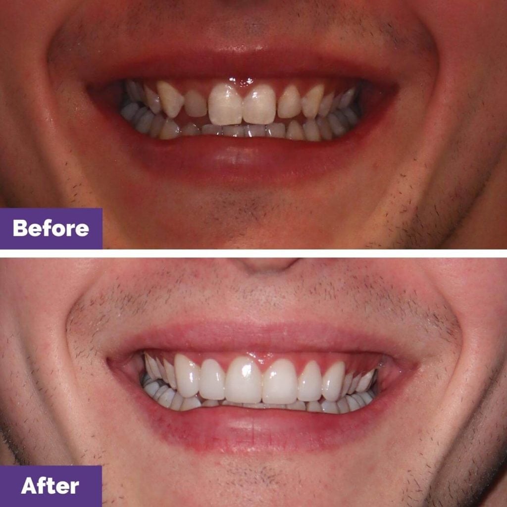 Kane Clark's Porcelain Veneers Journey in Sunbury