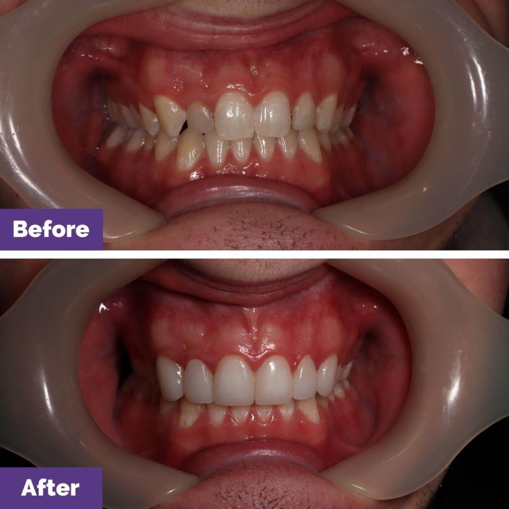 Kane Cs Porcelain Veneers Journey In Sunbury Kane C's Porcelain Veneers Journey in Sunbury
