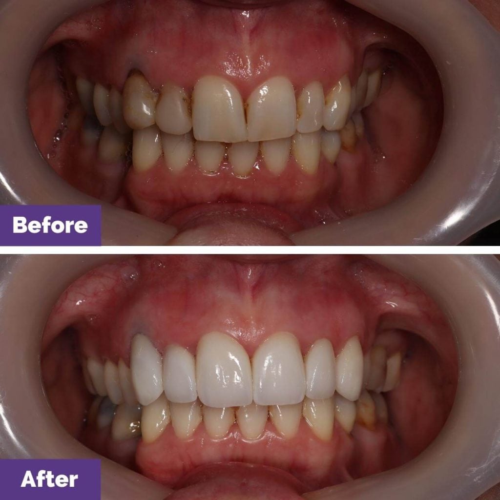 Karyn's Porcelain Crowns and Porcelain Veneers Journey in Sunbury