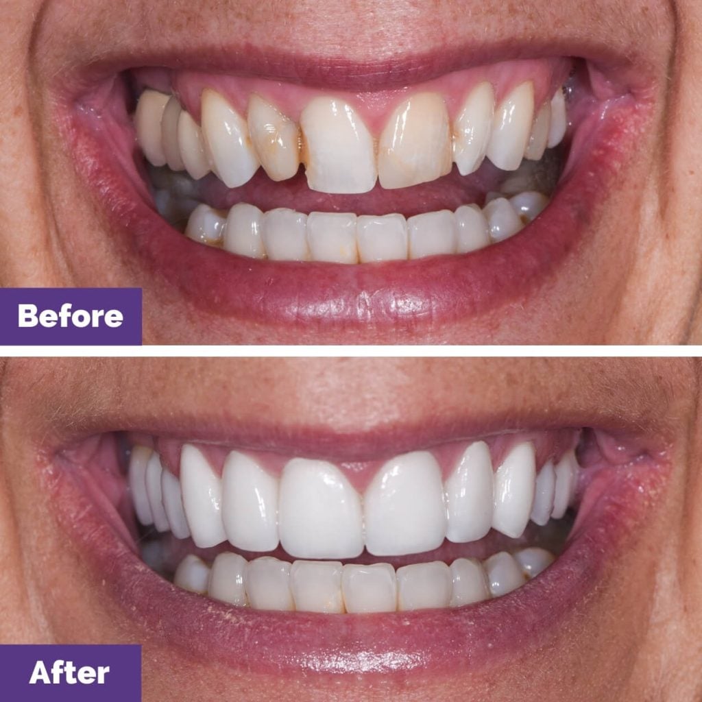 Kate's Porcelain Veneers Journey in Sunbury