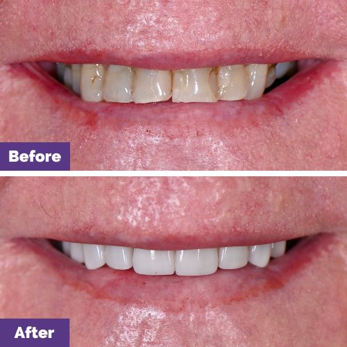 Kathy Of Sunbury’s Dental Veneers Journey Kathy Of Sunbury’s Dental Veneers Journey