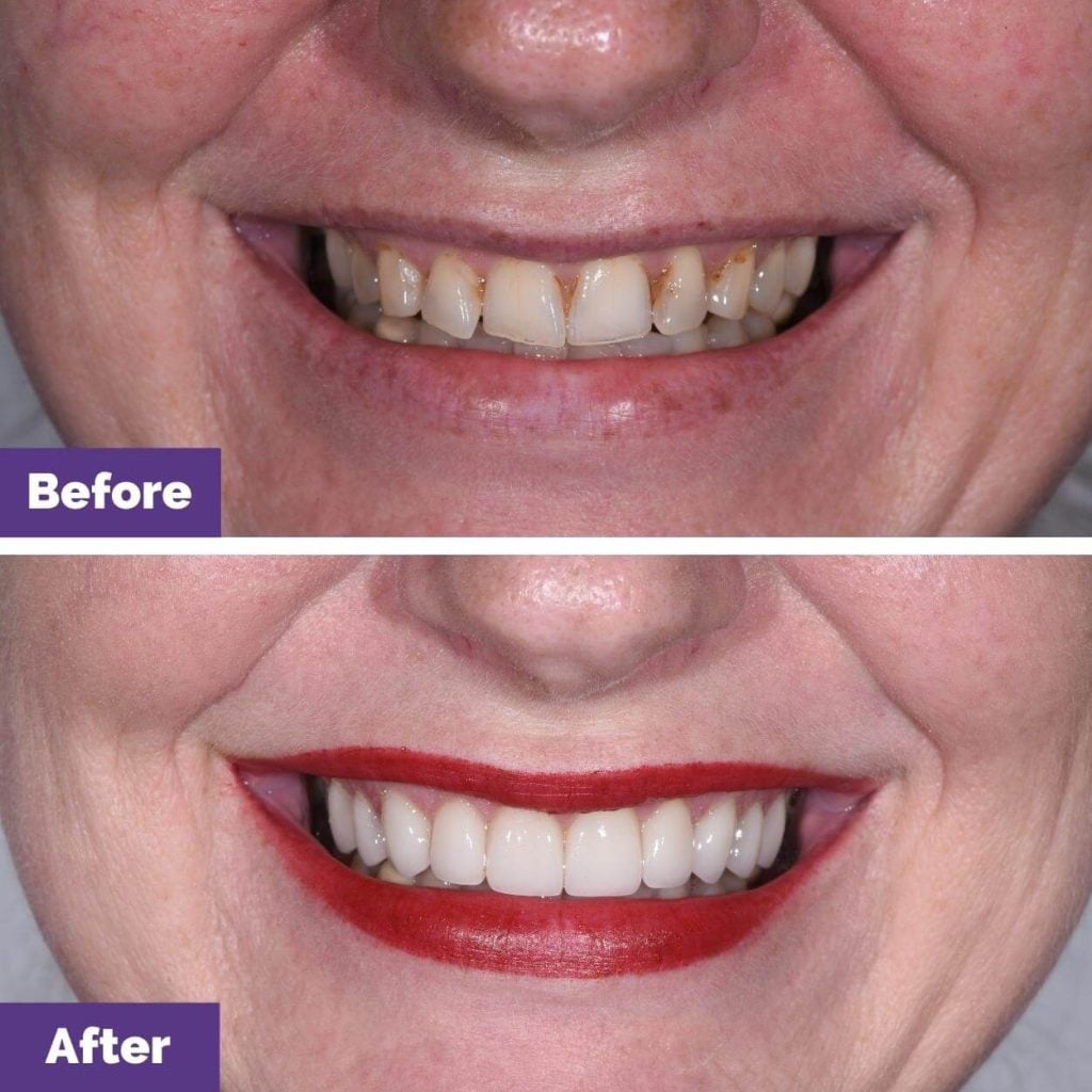 Kellie S's Porcelain Veneers Journey in Sunbury