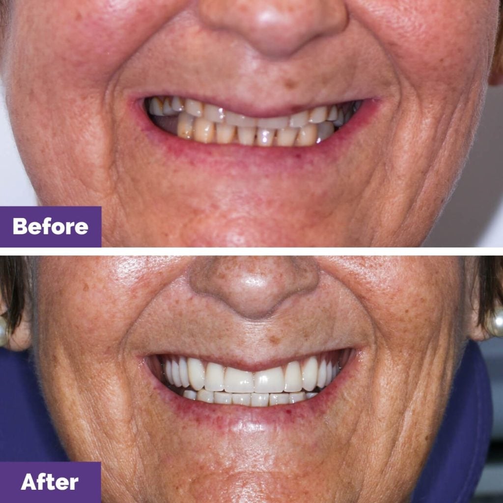 Kerry’s Porcelain Veneers And Crowns Journey In Bacchus Marsh Porcelain Veneers and Crowns in Bacchus Marsh Dental House