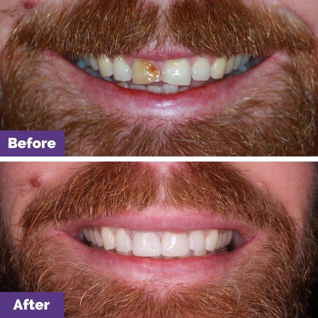 MC's Porcelain Veneers Journey in New Gisborne