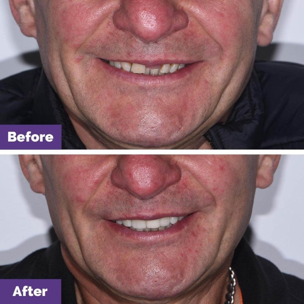 Marek's Dental Veneers and Dental Implants Journey in Sunbury