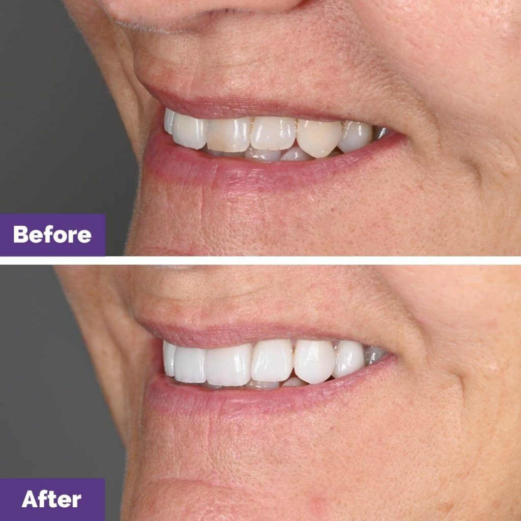 Mary Jane's Porcelain Veneers Journey in Sunbury