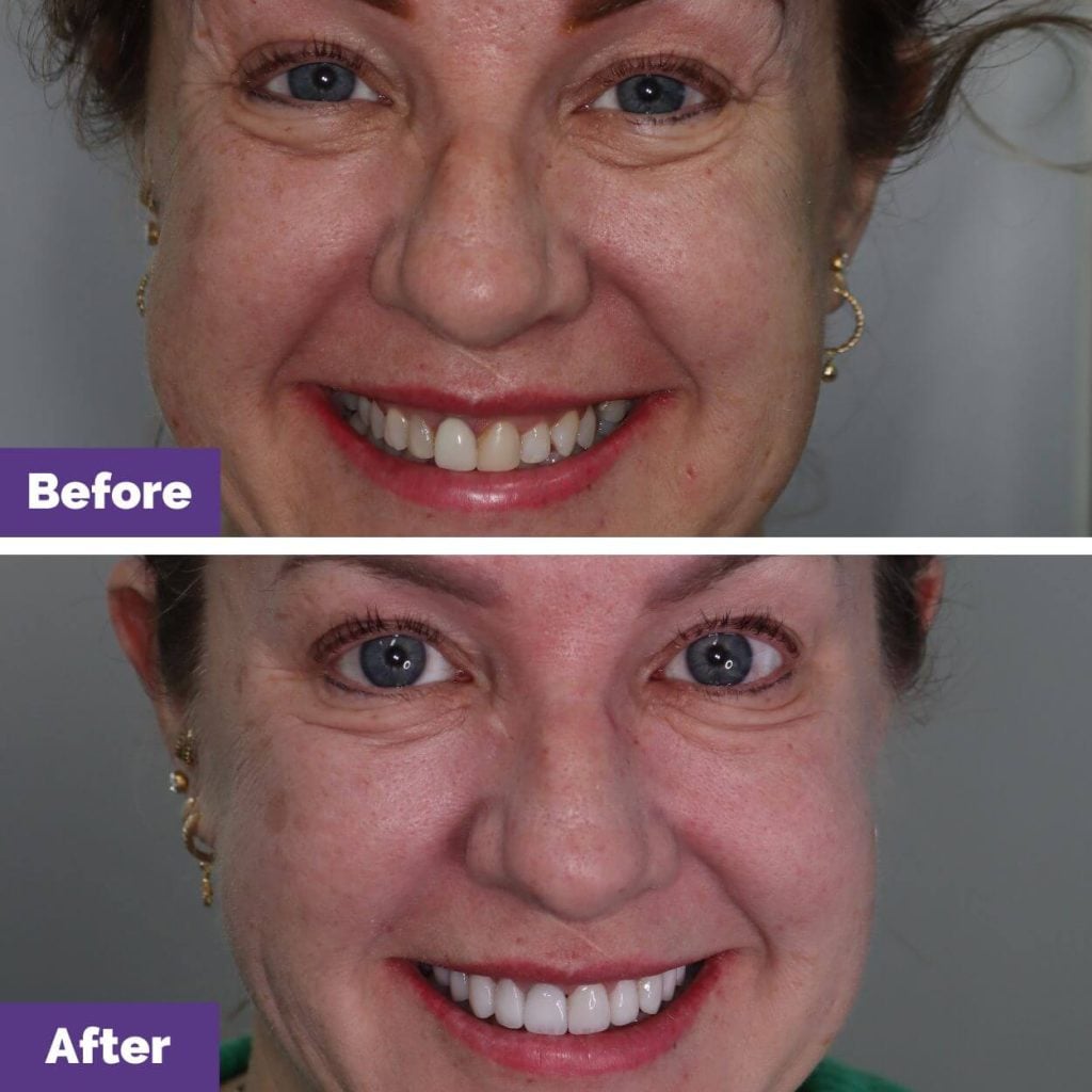 Melanie's Porcelain Crowns Veneers Journey In Sunbury