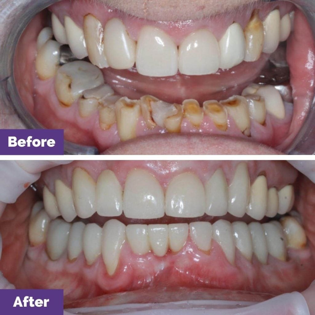 Ms. RW's Dental Veneers, Dental Crowns and Bridge Journey in Gisborne