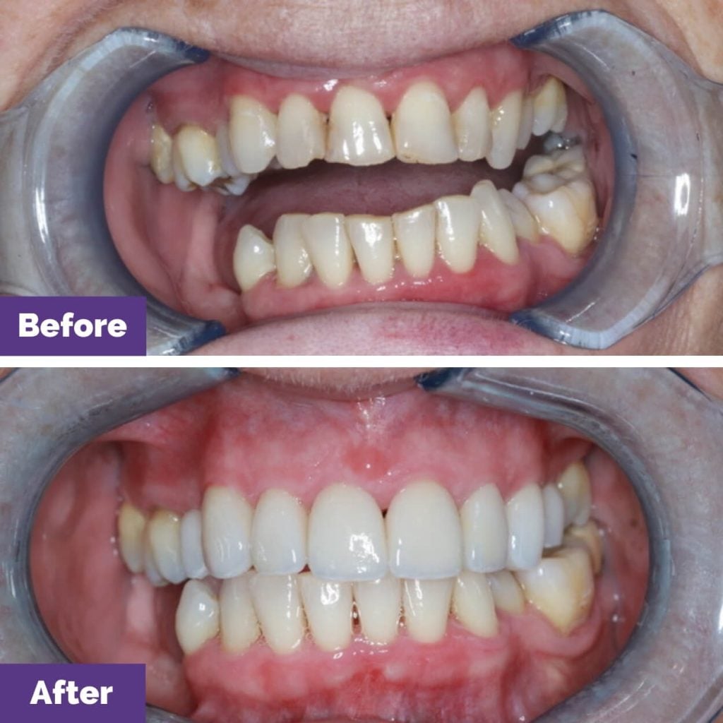 Ms. SS's Dental Veneers Journey in Gisborne