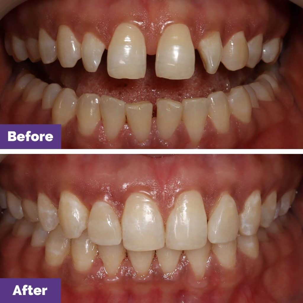 Nisha's Invisalign And Veneers Journey In Sunbury