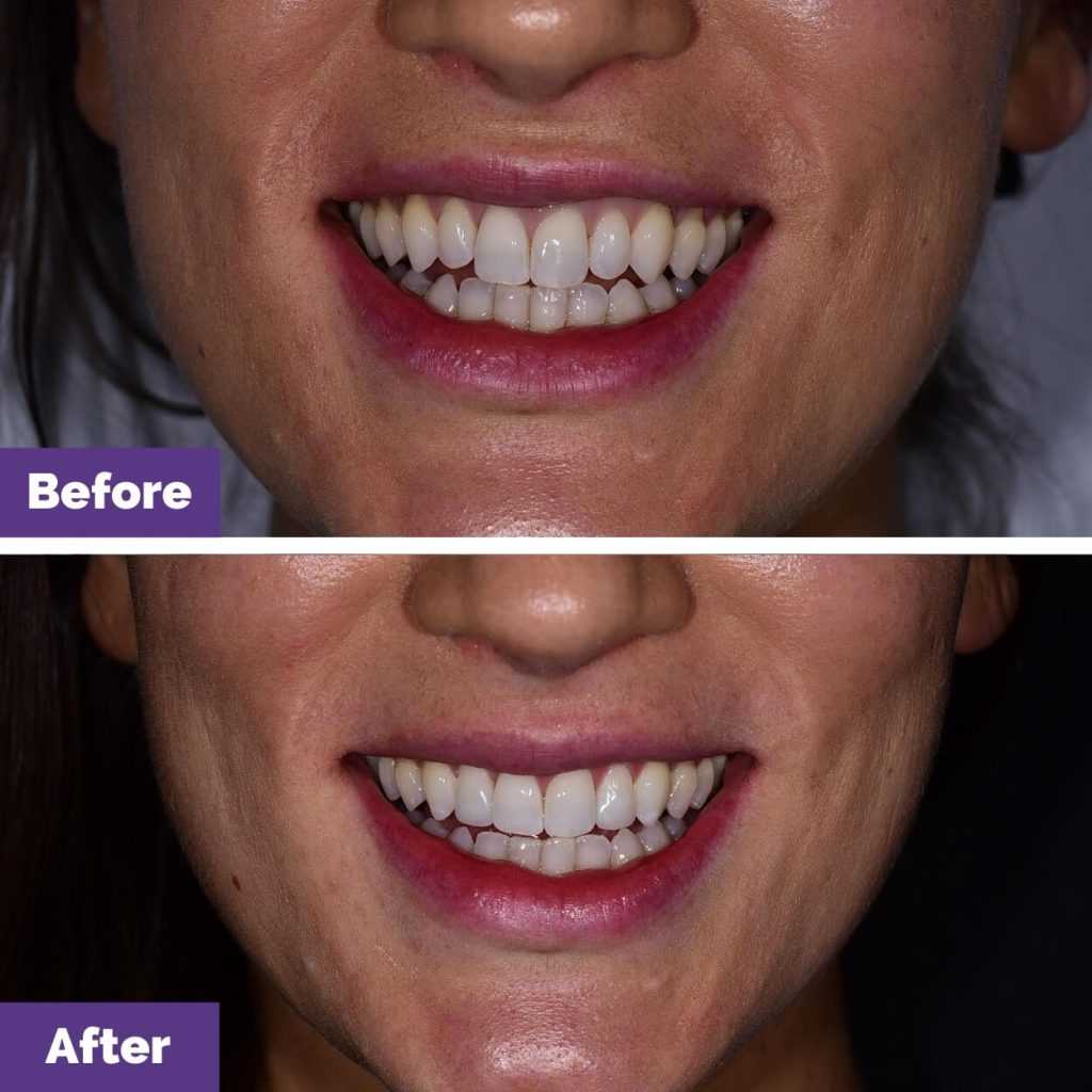Penny’s Invisalign And Composite Veneers In Melbourne Penny’s Invisalign and Composite Veneers in Melbourne