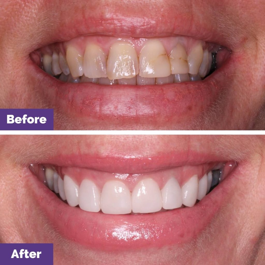 Porcelain Veneers Journey Close To Sunbury
