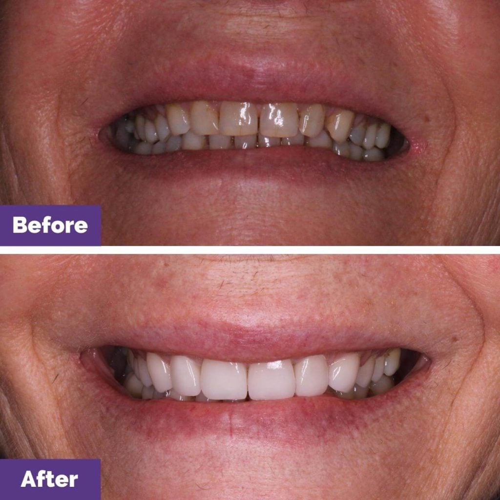 Porcelain Veneers Journey in Gisborne