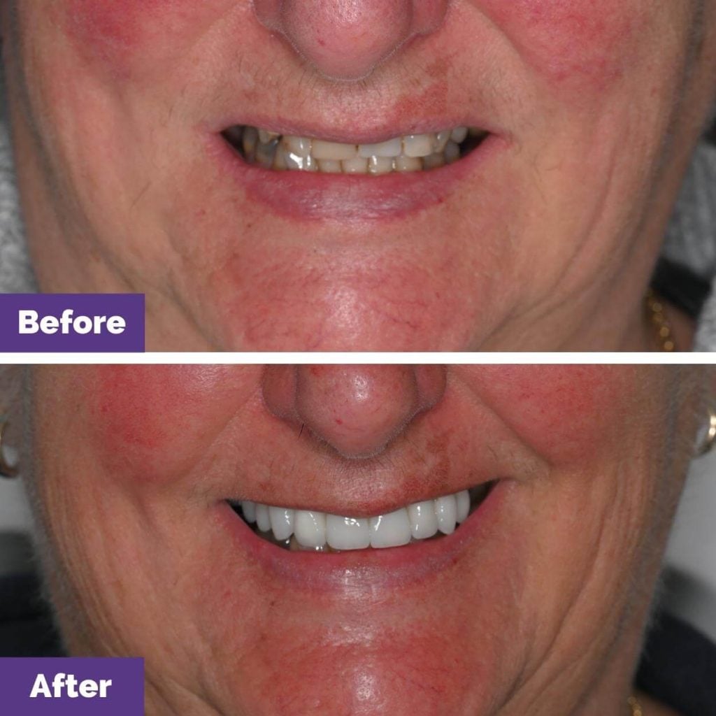 Porcelain Veneers Journey in Sunbury
