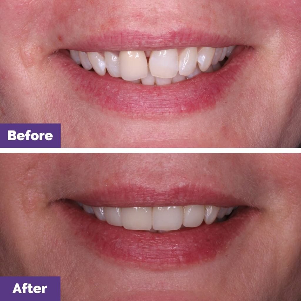 Porcelain Veneers Journey In Sunbury