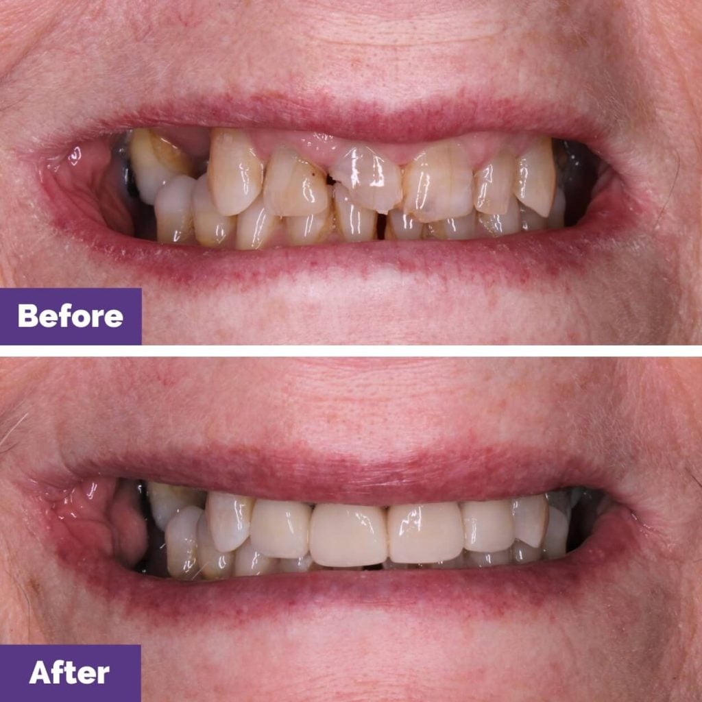 Porcelain Veneers Journey Near Sunbury