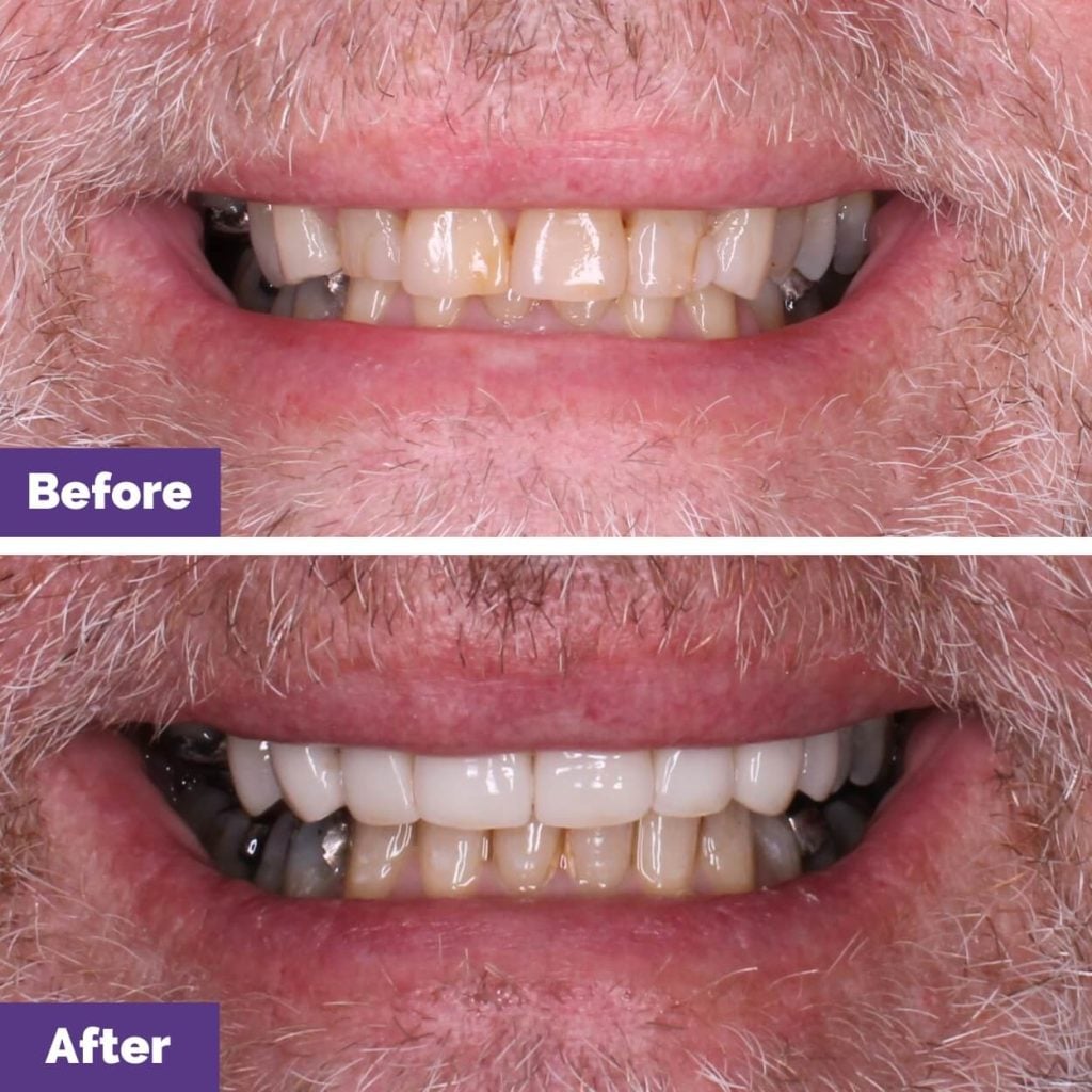 Porcelain Veneers Journey Nearby Sunbury
