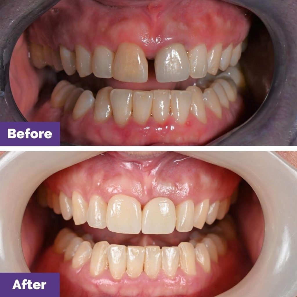 Rachael G’s Dental Implants And Invisalign Journey In Sunbury Rachael G's Dental Implants and Invisalign Journey in Sunbury