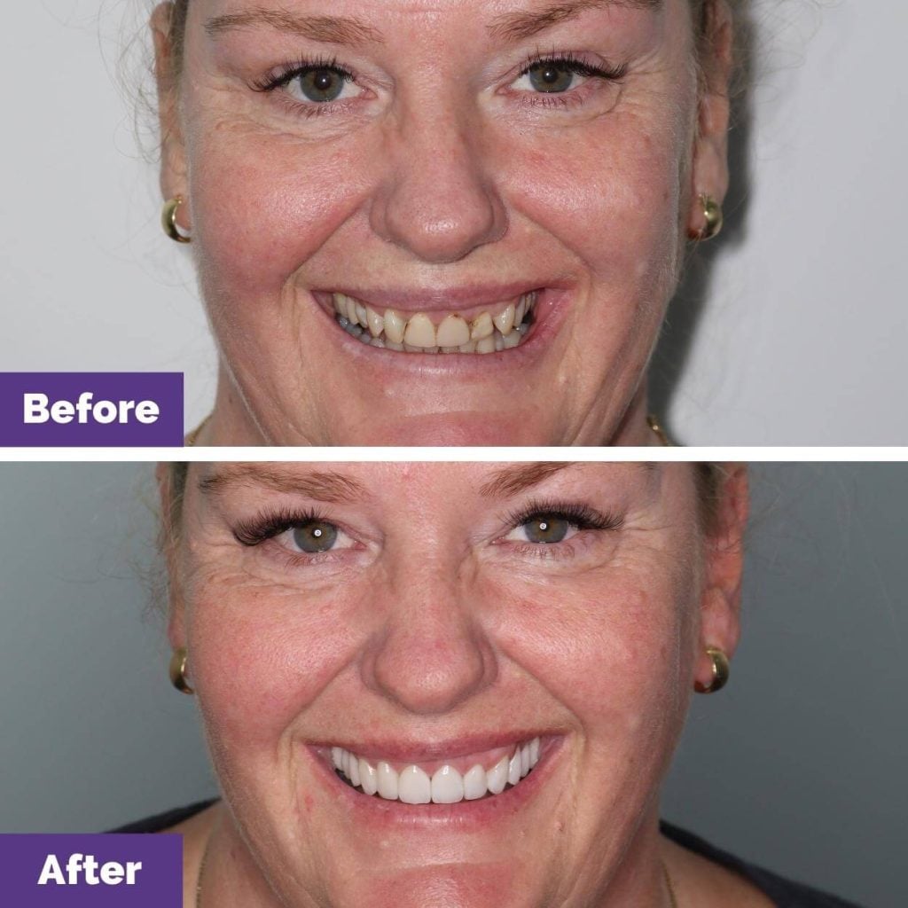 Sally's Porcelain Crowns and Porcelain Veneers Journey in Sunbury