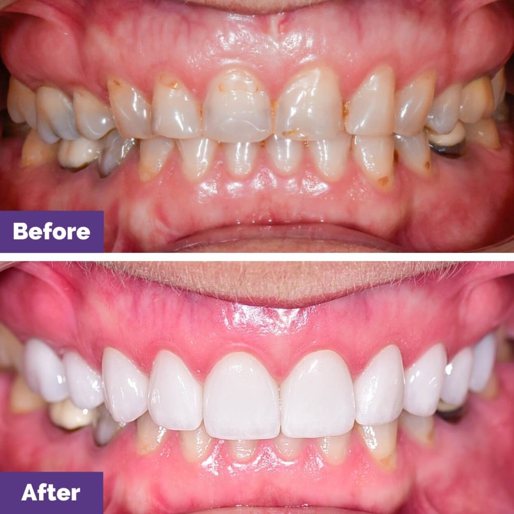 Sarah’s Porcelain Veneers Journey In Sunbury