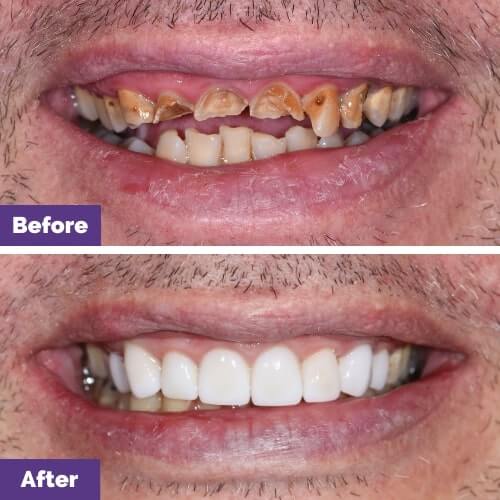 Scott Of Melbourne’s Dental Crowns, Veneers, And Root Canal Makeover