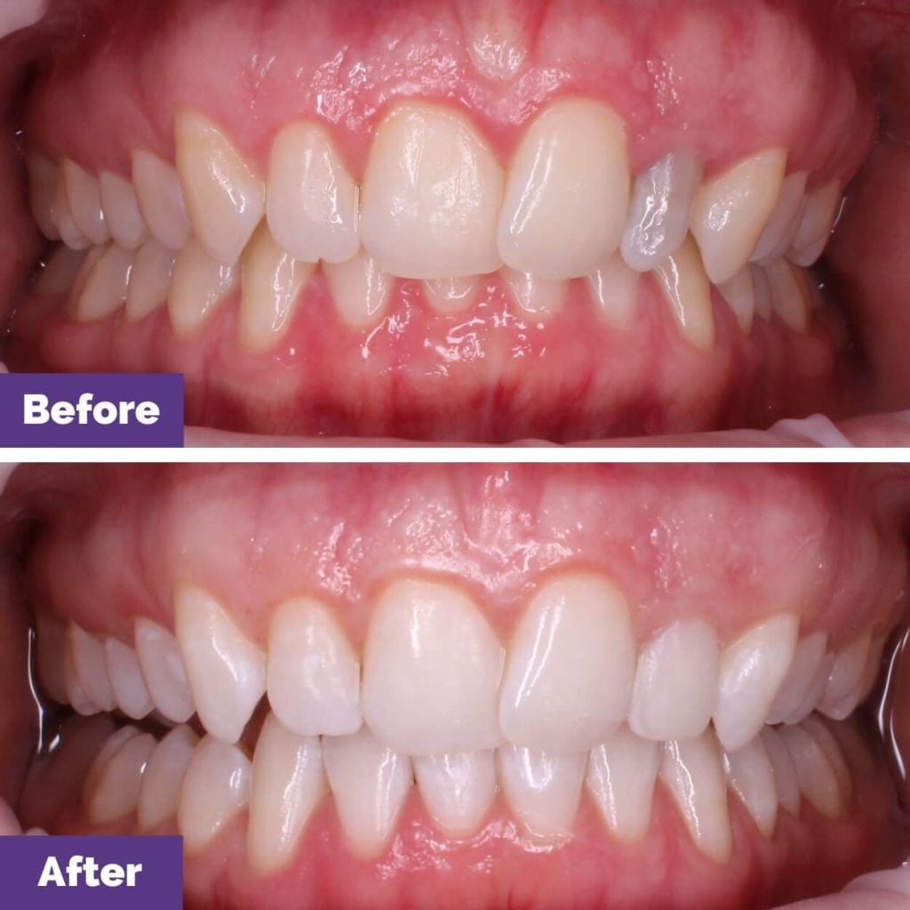 Teeth Whitening Journey At Sunbury
