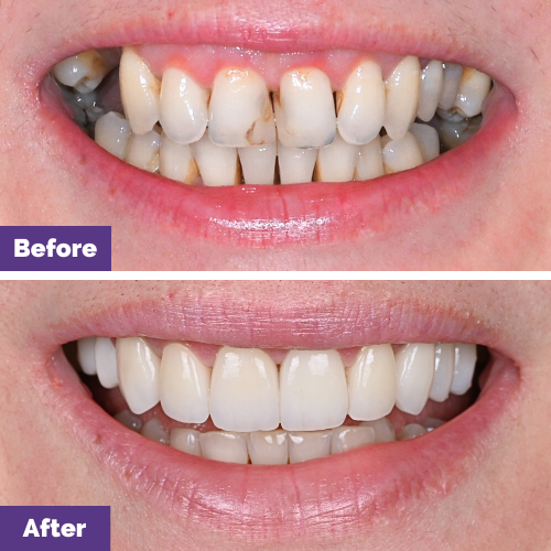 Violeta Of Melbourne’s Dental Implant And Veneers Journey In Dental House Violeta Of Melbourne’s Dental Implant And Veneers Journey