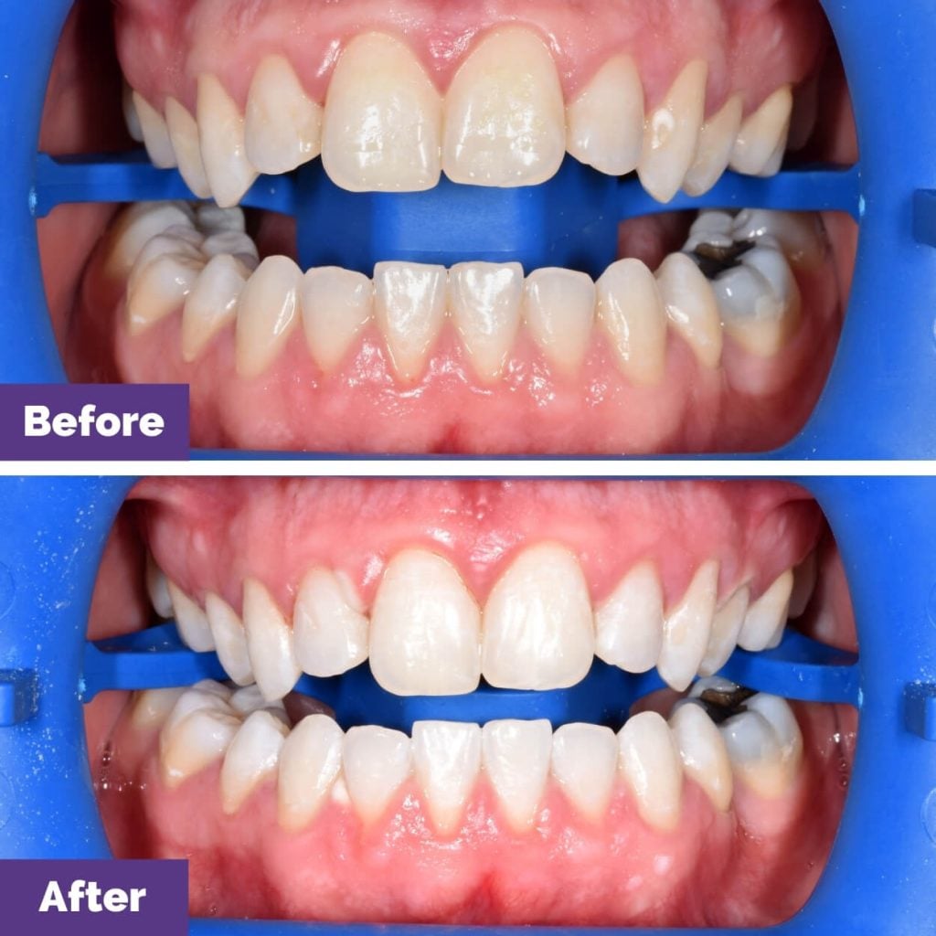 Whitening Journey in Sunbury